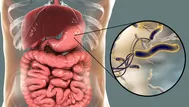 Helicobacter pylori: ¿cómo se contagia y cuáles son los síntomas?