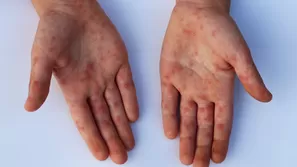 Las lesiones que aparecen en tu cuerpo cuando tienes viruela