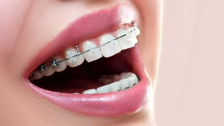 Lo que debes saber sobre los cuidados luego del uso de brackets