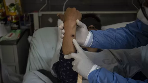 Paciente con una llaga causada por infección del virus de la viruela del mono (Foto: AFP)