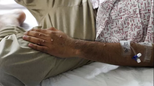 Las erupciones en la piel son uno de los principales síntomas de la viruela símica o Mpox. (Foto: Andina) Las erupciones en la piel son uno de los principales síntomas de la viruela símica o Mpox. (Foto: Andina)